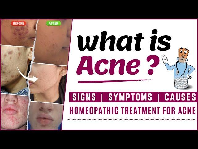Conventional Treatments vs Homeopathic treatment for Acne | HomoeoCARE