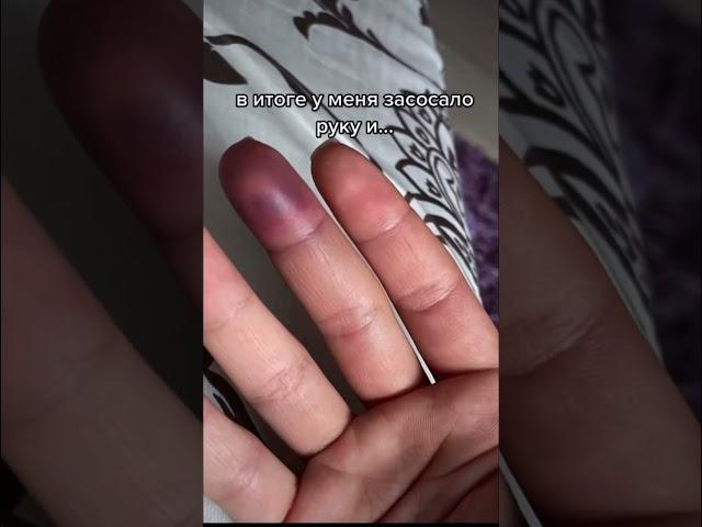 сломала палец