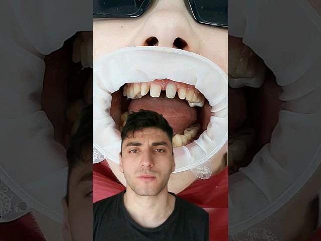 Как ставят виниры 