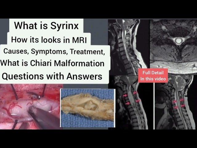 What is Syrinx or Syringomyelia | How it looks in MRI | Syrinx Causes Symptoms and Treatment