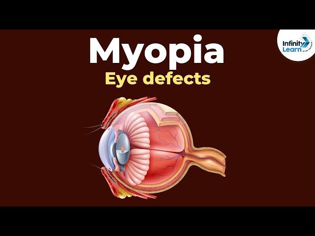 Eye defects - Myopia | Don't Memorise