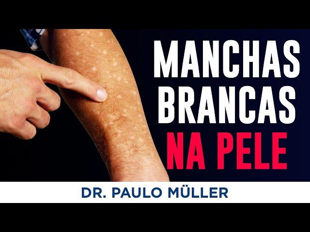 Leucodermia Solar – Manchinhas Brancas na Pele dos Braços e Pernas – Dr. Paulo Muller Dermatologista