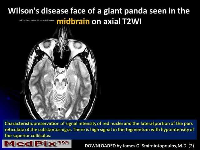 MedPix Week 666 Wilson's Disease from Kristin Kinsman, Jeffrey Pollock, MD Ryan Berecky, MD
