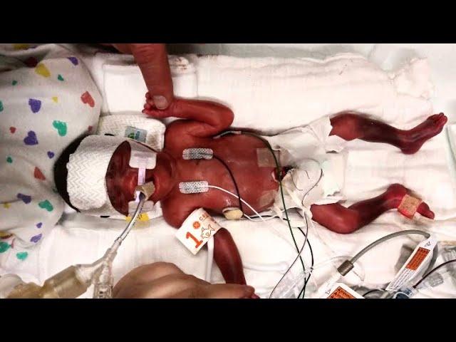 Premature twins are first in NE Ohio to receive newly approved treatment