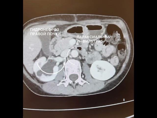 Гидронефроз правой почки и параксиальный инфильтрат вдоль нижней полой вены.