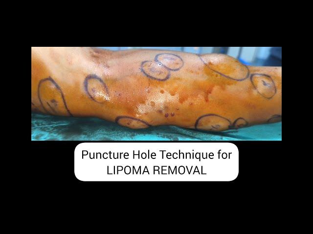 20 MINUTES 25 LIPOMA REMOVAL | MULTIPLE LIPOMA REMOVAL #lipo #LIPOMA #pimplepopping #pimplepopper