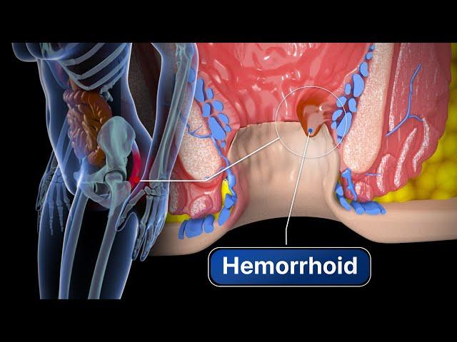 Hemorrhoid Removal | Step by step