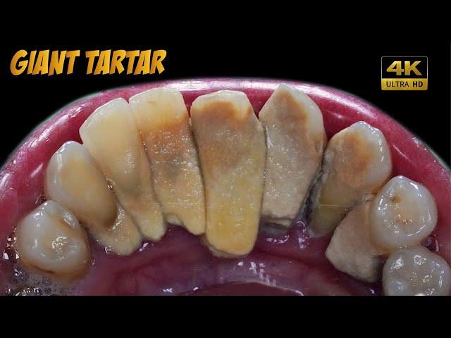 4K UHD | 55yo. Female's Teeth | Giant Tartar | Dentist | Dokter Gigi Tri Putra