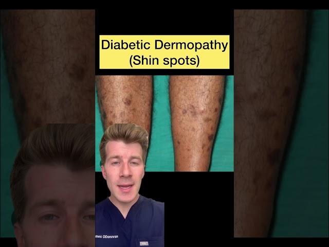 12 skin conditions linked with diabetes … #shorts #diabetes #dermatology #doctor #health