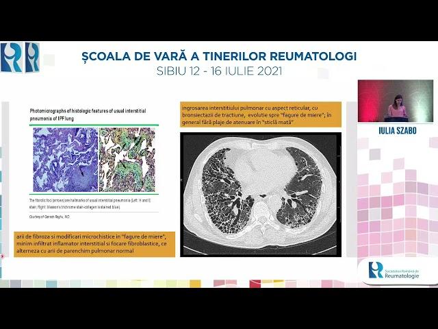 Pneumopatia interstitiala difuza - Iulia Szabo