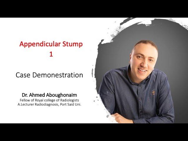 | GIT | Acute abdomen | Appendicular stump & Ruptured ovarian cyst |