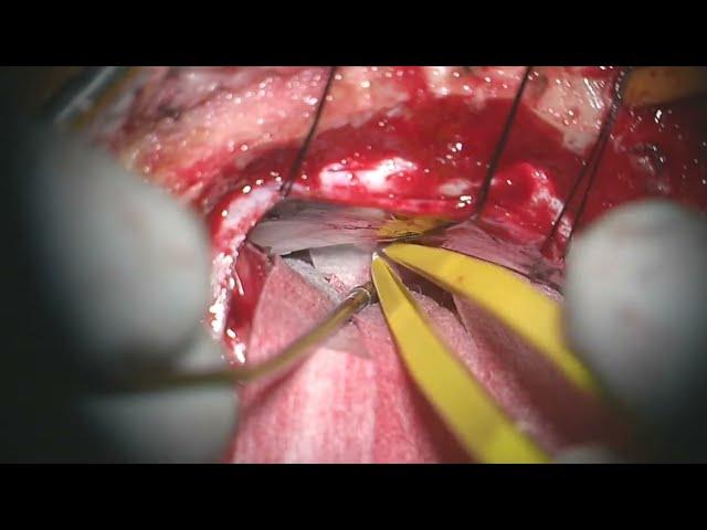 Lateral Supracerebellar Approach for Resection of a Pineoblastoma (Preview)