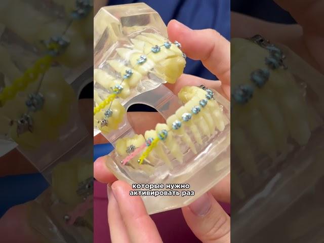 Хотите поставить брекеты, но не знаете какие?