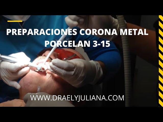 Preparación de Coronas Metal Porcelana  video 3-15