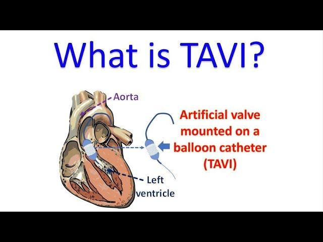 What is TAVI?