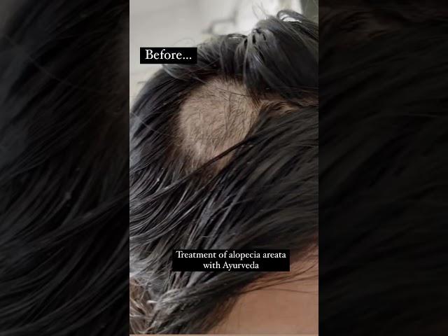 Treatment for Alopecia areata with Ayurveda | Dr. Rekha