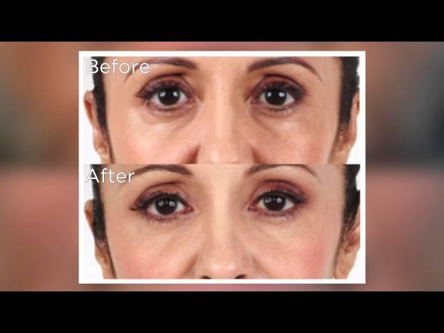 Non-Invasive Injectable Fillers for Volume Loss | Maryland Laser Skin & Vein