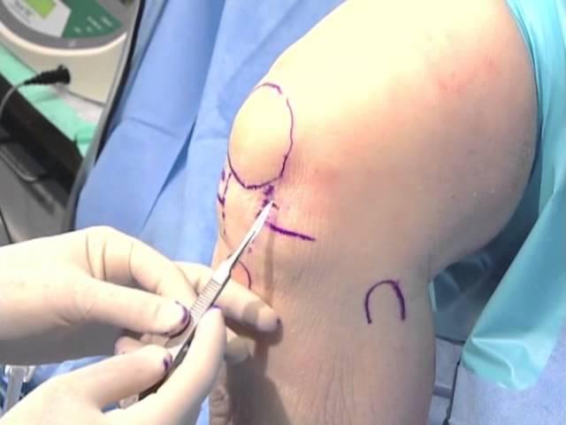 Arthroscopic Knee Surgery Video Part 2: Surface Anatomy & Placement | Albuquerque Orthopedic Surgeon