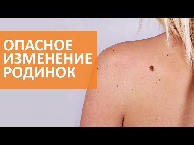  Признаки опасных изменений родинки ¦ Дерматолог клиники Семейный доктор