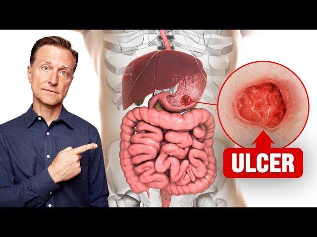 The FASTEST Way to Heal an Ulcer