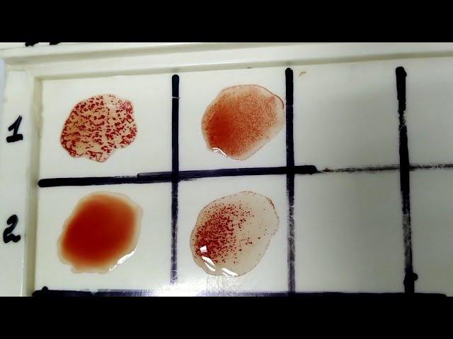 Сross blood group/ГРУППА КРОВИ. КАК ОПРЕДЕЛИТЬ ПЕРЕКРЁСТНЫМ МЕТОДОМ