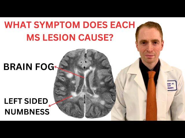 What Symptom Does Each Multiple Sclerosis MRI Lesion Cause?  Neurologist Explains