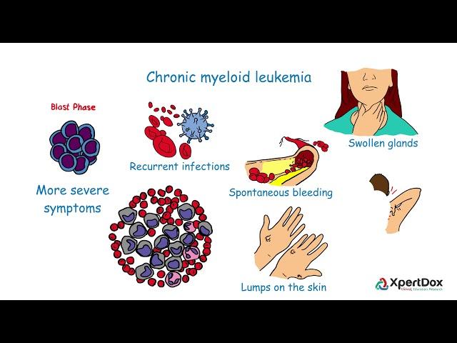 What is Chronic myeloid leukemia?