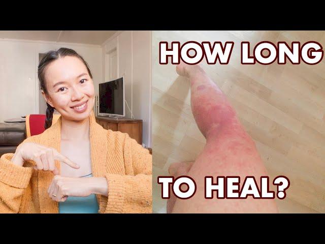 How Long to Heal Eczema