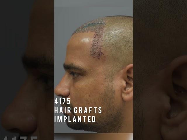 5 Months Hair Transplant Results [Before After] #hairtransplantinindia