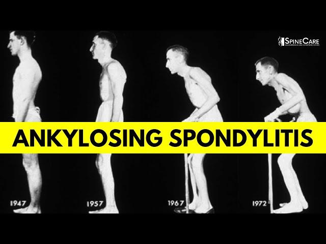 What is Ankylosing Spondylitis? Causes, Symptoms, and Diagnosis EXPLAINED