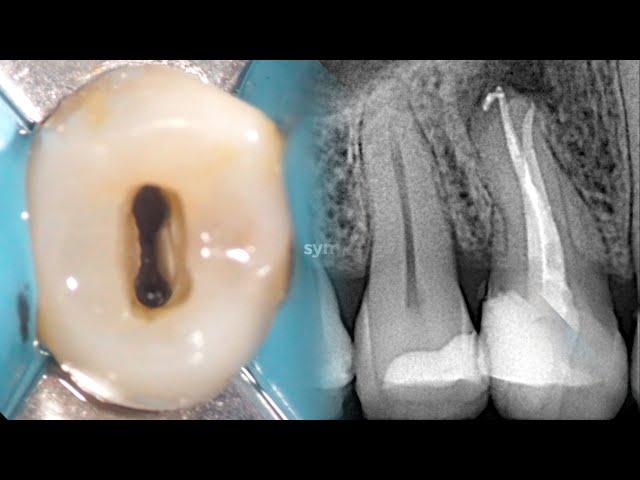 Root Canal Treatment Upper First Premolar