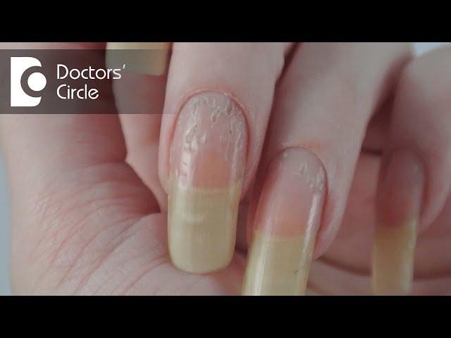 What can cause deep holes in nails & is it related to stress? - Dr. Nischal K