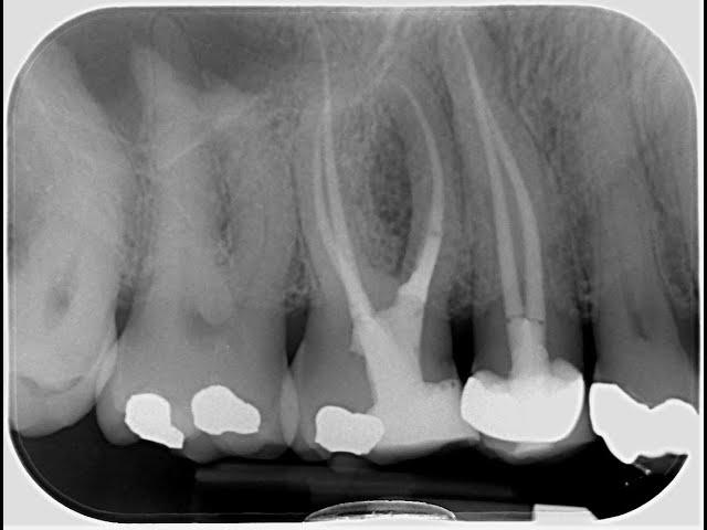 Maxillary molar access