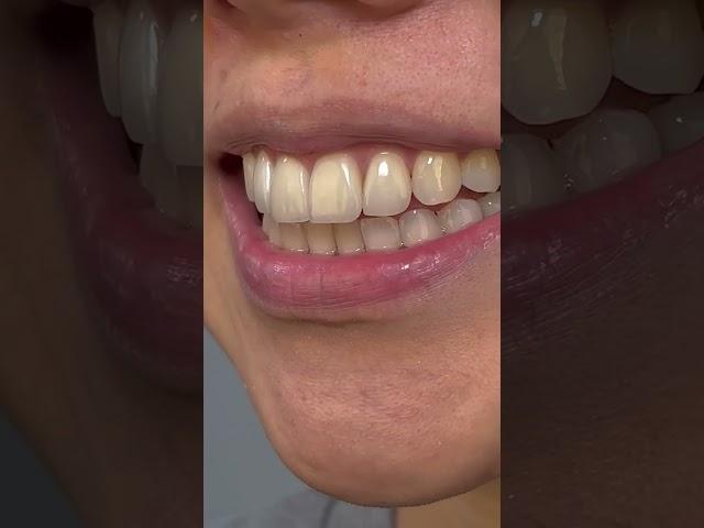 4 Veneers for this dentist patient.  #readdescription #veneers #dental