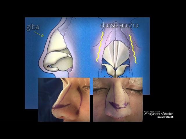 Tabique Nasal Correción de giba