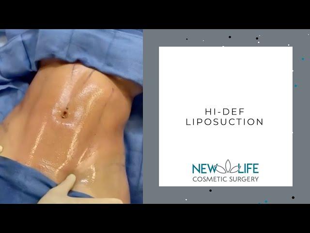 Hi-Def Liposuction | Cosmetic Surgeon | Mcallen, Texas