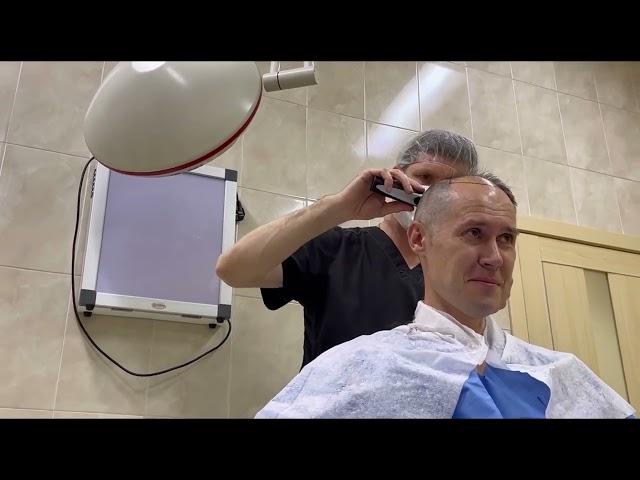 Пересадка волос в Москве в клинике Real Trans Hair. 2200 графтов