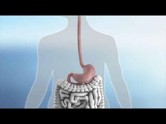 Sleeve Revision Animation, Grand Strand Bariatric Surgery