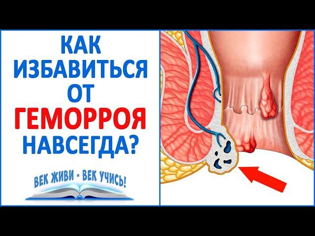 ГЕМОРРОЙ. Как избавиться от Геморроя раз и навсегда! Острый и хронический Геморрой!