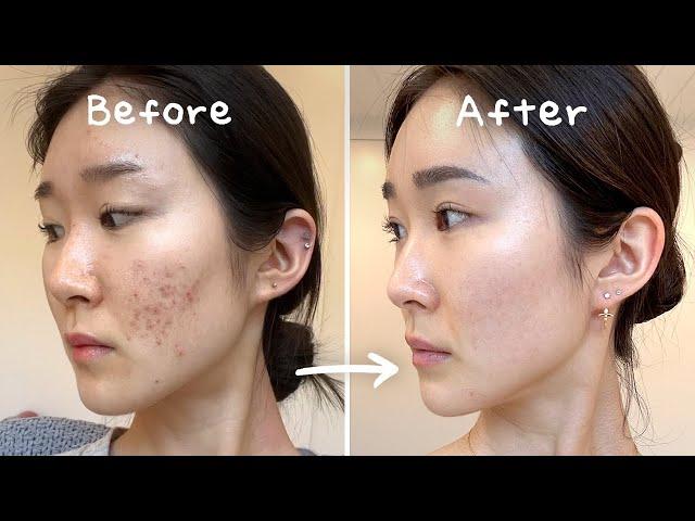 3 Secrets to Clearing Acne Without Medication (No Accutane / Tretinoin)