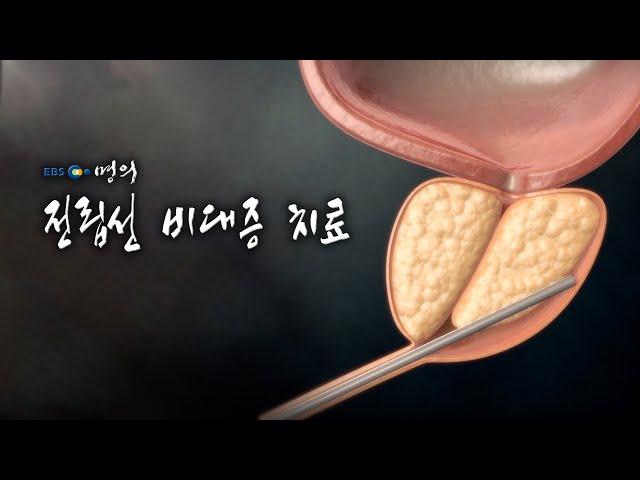 [명의 의학백과] 전립선 비대증 치료