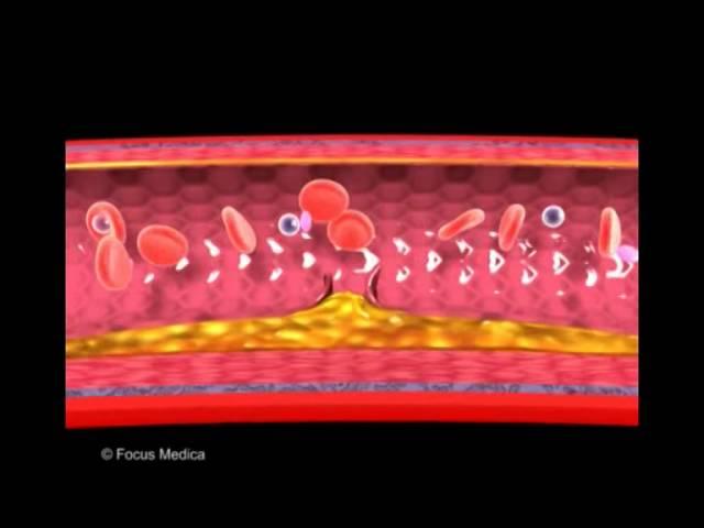 Atherosclerosis and thrombus formation - Heart