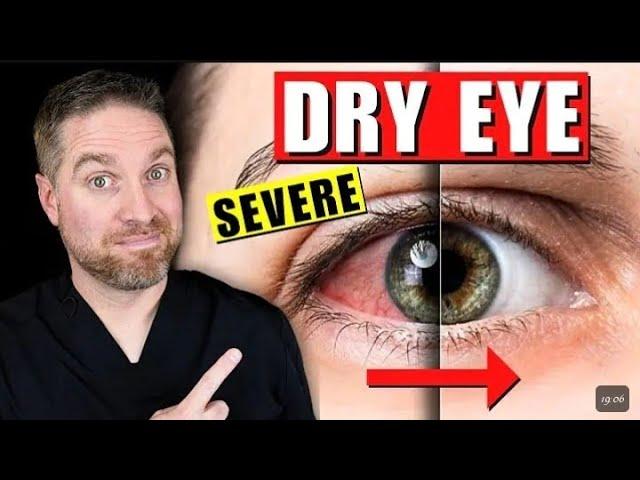 After 14 Days, My Chronic Dry Eyes & Redness Were Gone – Natural Dry Eye Treatment That Works!