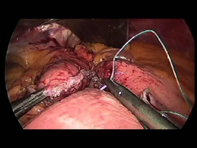 Gastric Bypass Surgery Demonstration: Memorial Weight-Loss Surgery Program