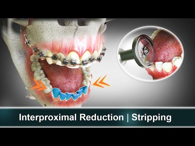 Interproximal Reduction (IPR) | Stripping | Orthodontic Treatment | Curveia Dental Animation