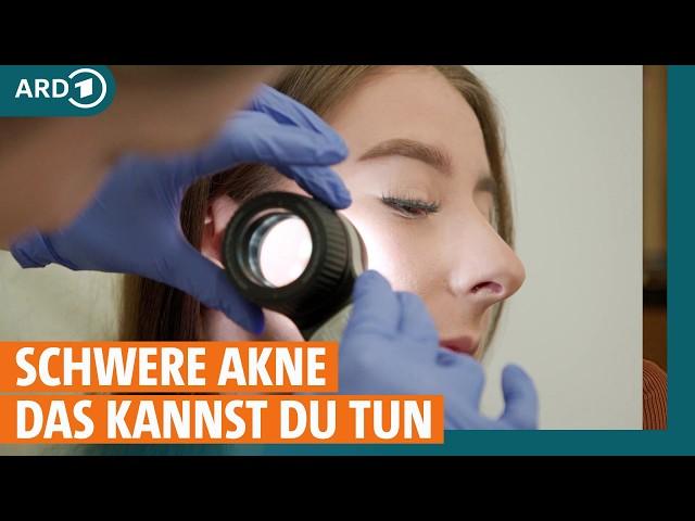 Akne – Was hilft bei Pickeln, Pusteln und Mitessern? I ARD Gesund | Re-Upload