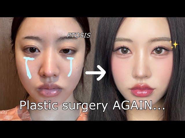 I got my eyes done AGAIN in korea Plastic surgery vlog!