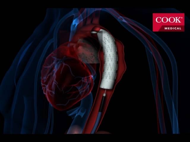 Thoracic Endovascular Aortic Repair (TEVAR)