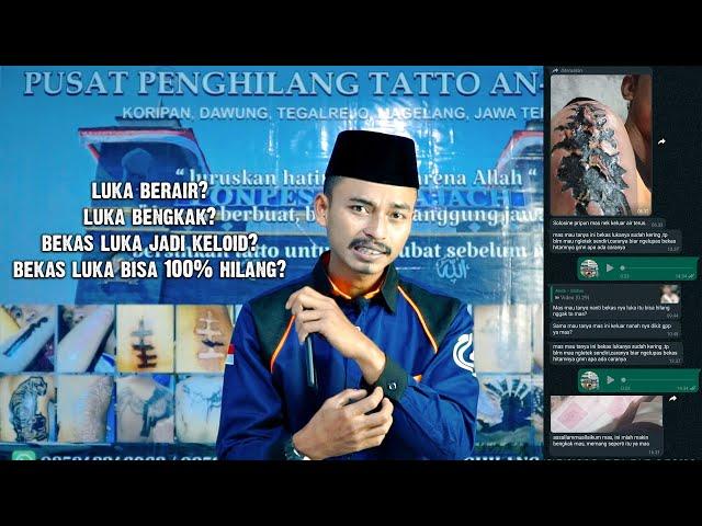 CARA MERAWAT LUKA BEKAS HAPUS TATTO (Q&A)