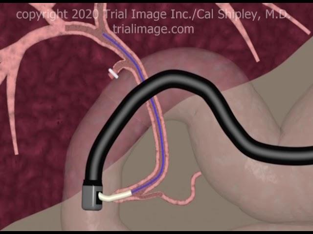 Stricture of the Common Hepatic Duct Animation by Cal Shipley, M.D.